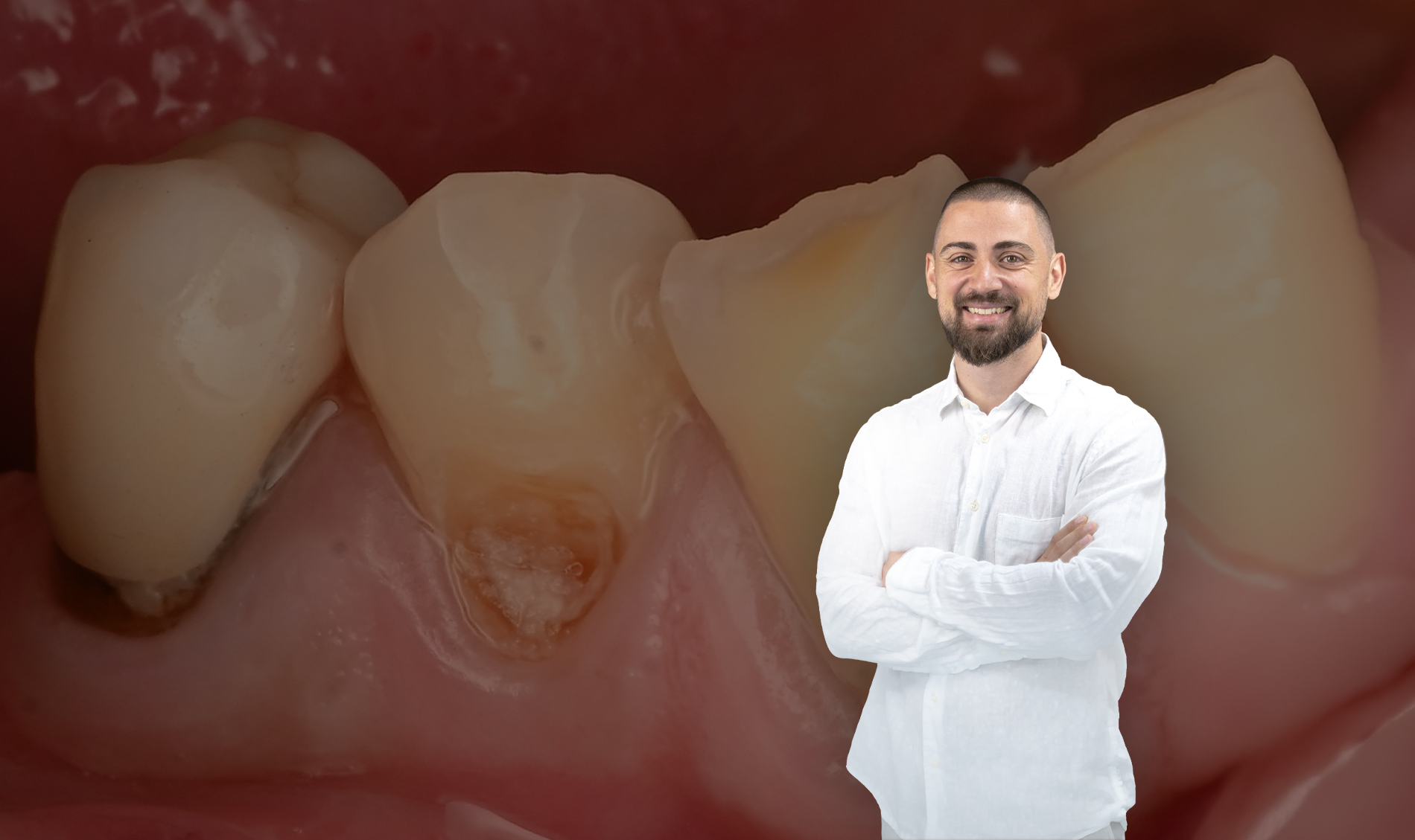 Primary root canal treatment of tooth 44 presenting with an apical spit